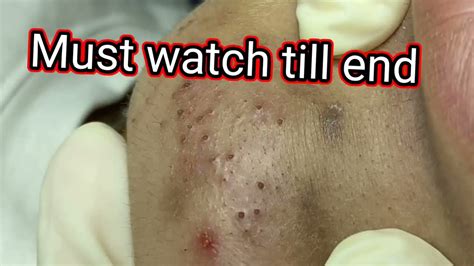 This video is about removing a huge blackhead in the ear. . Blackhead spa